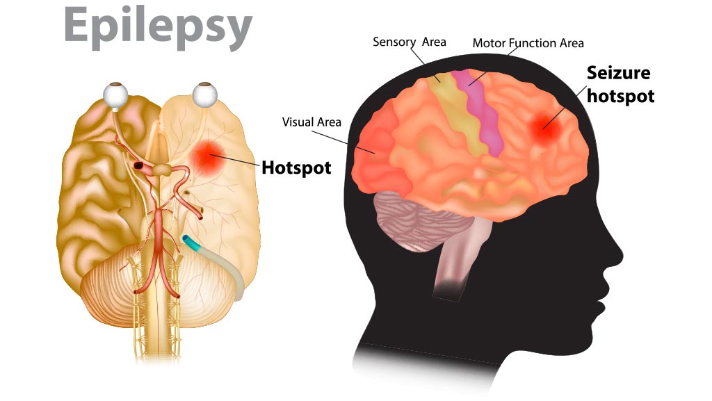 cannabidiol in the treatment of epilepsy